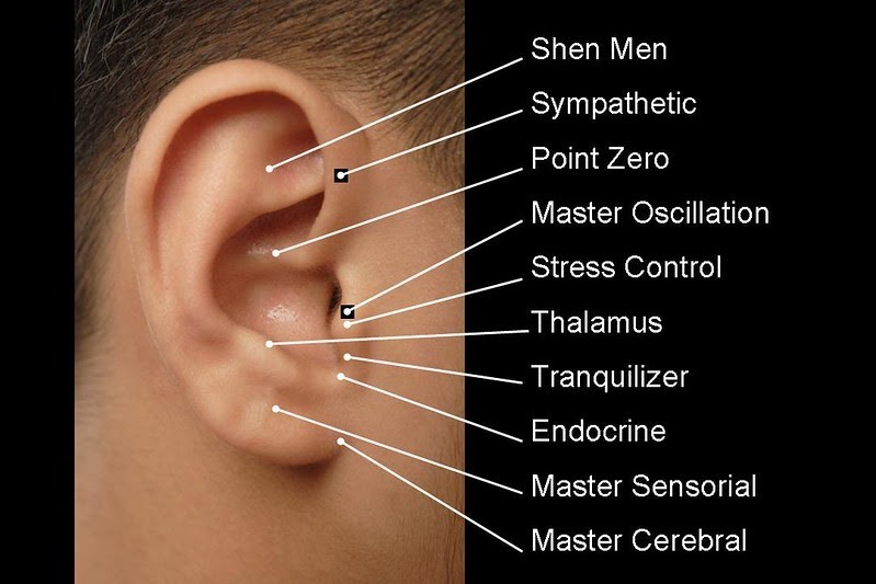 ear acupuncture