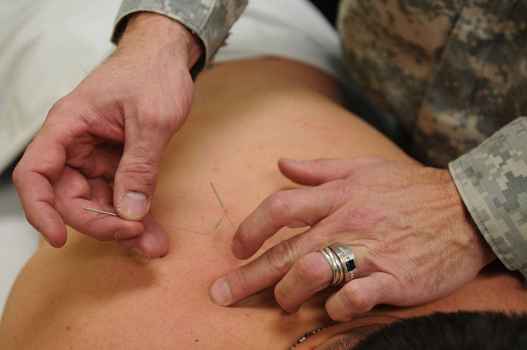 acupuncture for backpain
